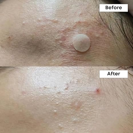 NINELESS A-Control 10% Azelaic Acid Serum-30ml - Image 5